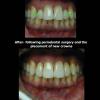Periodontal Surgery by Dr. Adam.