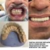 A partial upper denture was replaced by a fixed bridge to create a beautiful smile.  