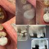 This patient had discomfort and wanted to remove his tooth.  Instead we saved it with root canal therapy.
Then we restored the tooth with a direct resin onlay.  